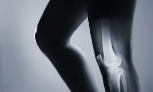 Sklerotyzacja stropu panewki: co to znaczy i jak wpływa na zdrowie?